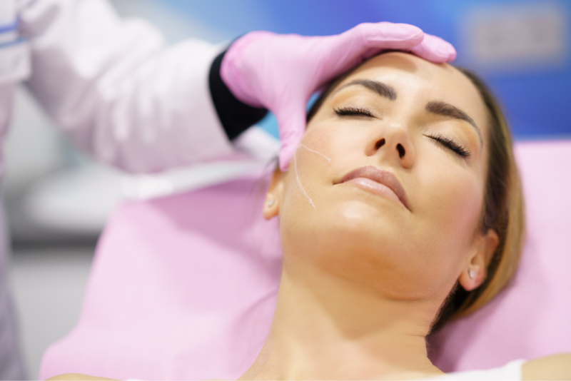 Aesthetic provider preparing to perform a PDO thread lift on a woman’s cheek, marked with thread insertion lines.