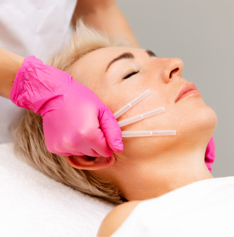 Close-up of a patient undergoing a PDO thread lift procedure, with a practitioner inserting facial threads while wearing pink gloves.
